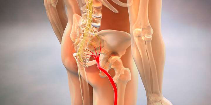 ما هو عرق النسا وأسبابه؟