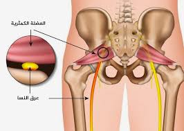 طرق علاج عرق النسا